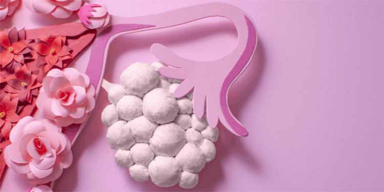 多囊性卵巢症候群（PCOS）